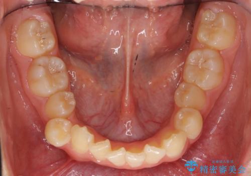 埋まっている犬歯を抜歯して、歯列矯正の治療前