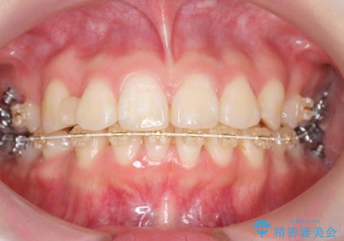 成人式に間に合う 前歯の矯正の治療中