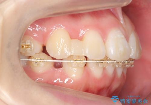 成人式に間に合う 前歯の矯正の治療中