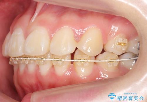 成人式に間に合う 前歯の矯正の治療中