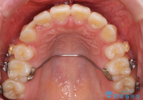 成人式に間に合う 前歯の矯正の治療中