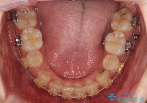 成人式に間に合う　前歯の矯正の治療中