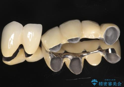歯周病におかされた前歯の再建治療の治療後