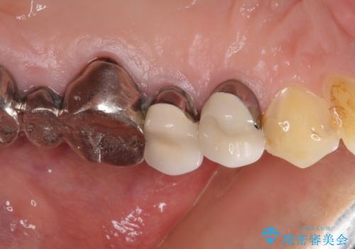 歯肉の縁に金属が見えて気になる　オールセラミッククラウンによる審美歯科治療の治療前