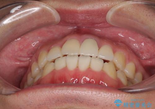 前歯の歯並びとクラウンを改善 インビザラインとオールセラミックの治療後