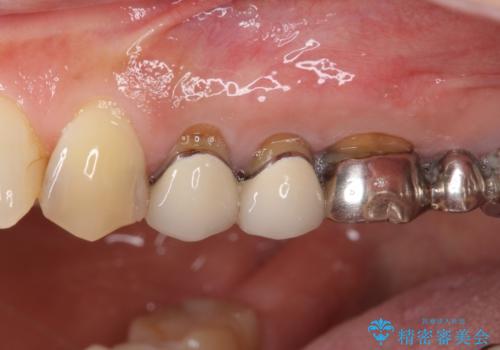 歯肉の縁に金属が見えて気になる　オールセラミッククラウンによる審美歯科治療の症例 治療前