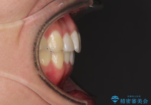 前歯の歯並びとクラウンを改善 インビザラインとオールセラミックの治療後