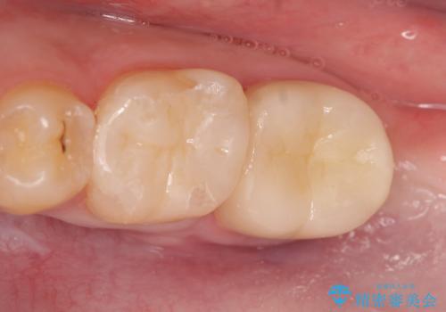 歯冠長延長術を併用した審美的セラミック治療の治療後