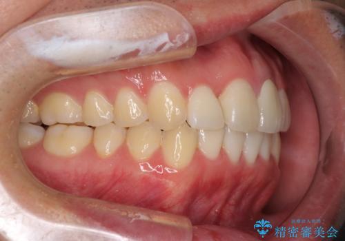 前歯の歯並びとクラウンを改善　インビザラインとオールセラミックの治療後