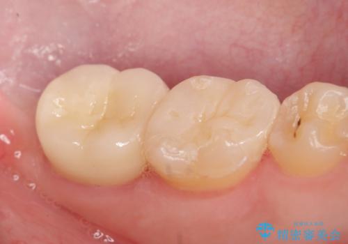 歯冠長延長術を併用した審美的セラミック治療の治療後