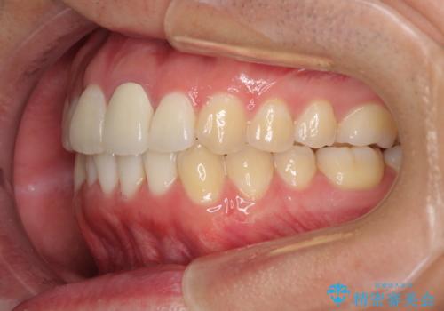 前歯の歯並びとクラウンを改善 インビザラインとオールセラミックの治療後