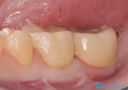 歯冠長延長術を併用した審美的セラミック治療の治療後