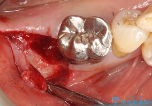 歯周病にて保存不可能な歯をショートインプラントで回復するの治療中