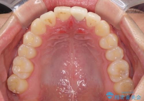 前歯の歯並びとクラウンを改善 インビザラインとオールセラミックの治療後