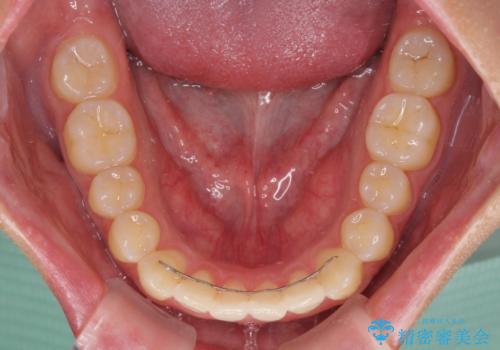 前歯の歯並びとクラウンを改善　インビザラインとオールセラミックの治療後