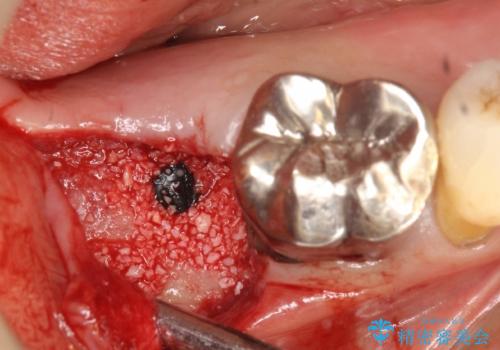 歯周病にて保存不可能な歯をショートインプラントで回復するの治療中