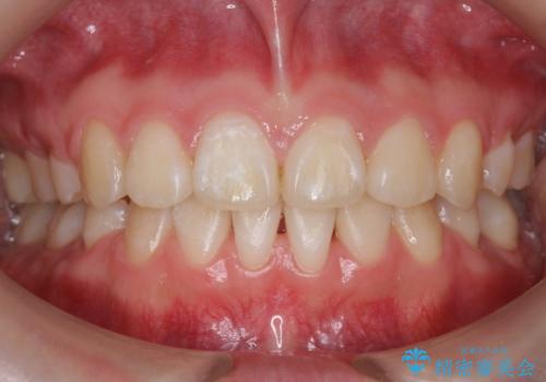 成人式に間に合う 前歯の矯正の症例 治療後