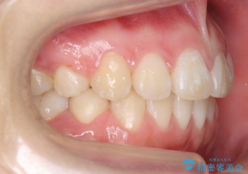 成人式に間に合う　前歯の矯正の治療後
