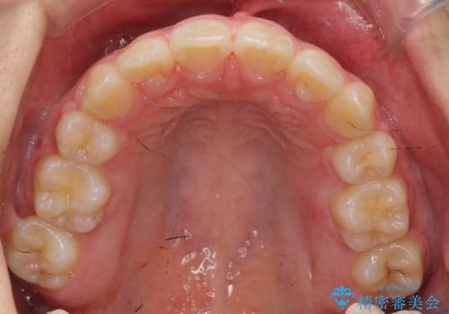 成人式に間に合う 前歯の矯正の治療後