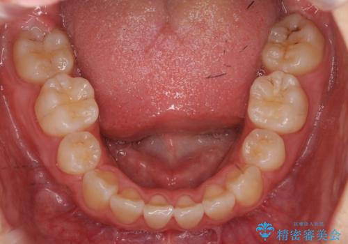 成人式に間に合う　前歯の矯正の治療後