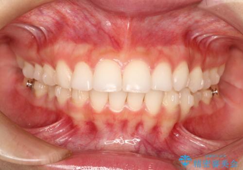 出っ歯の矯正治療 歯を抜かずにインビザラインでの治療中