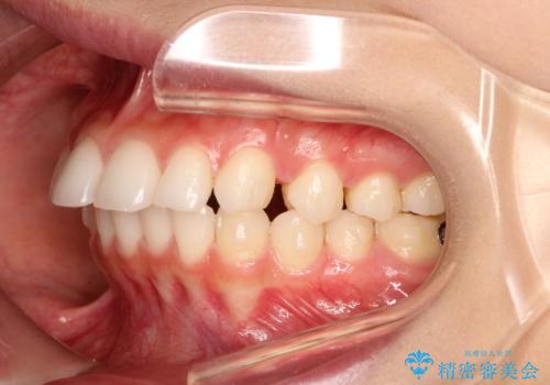 出っ歯の矯正治療 歯を抜かずにインビザラインでの治療中