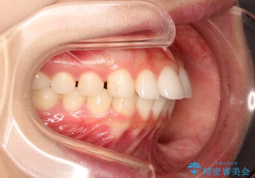 出っ歯の矯正治療 歯を抜かずにインビザラインでの治療中
