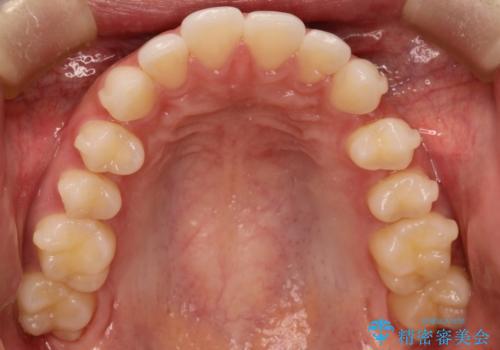 出っ歯の矯正治療 歯を抜かずにインビザラインでの治療中