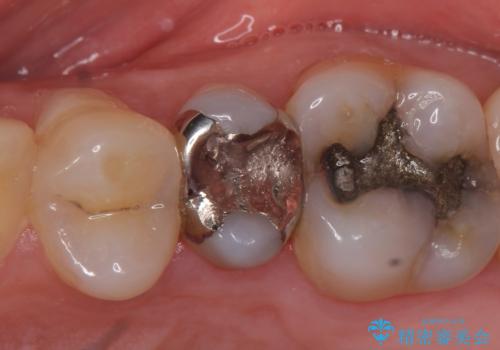 オールセラミッククラウン しみる歯の治療の症例 治療前