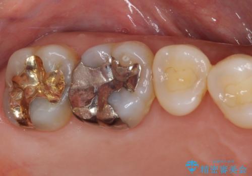外れてしまった奥歯の銀歯 ゴールドインレーによる修復治療