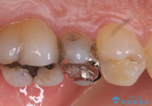 オールセラミッククラウン しみる歯の治療の治療前