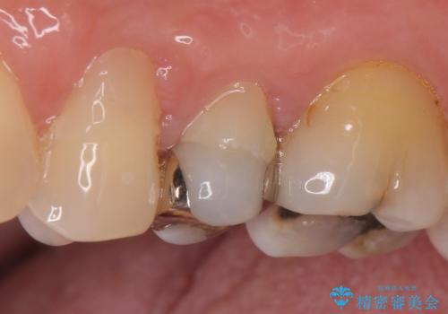 オールセラミッククラウン しみる歯の治療の治療前
