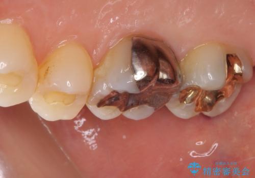 外れてしまった奥歯の銀歯 ゴールドインレーによる修復治療の治療後
