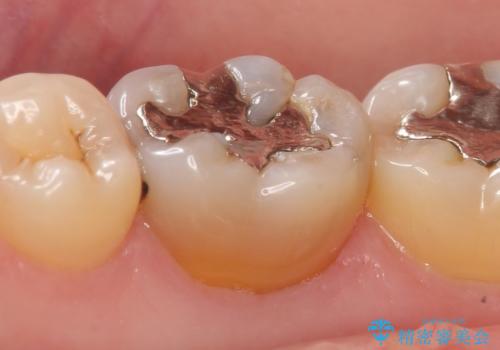 セラミックインレー 虫歯治療の治療前