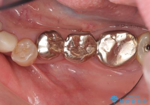 オールセラミッククラウン　銀歯を白い歯への症例 治療前