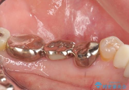 オールセラミッククラウン 銀歯を白い歯への治療前