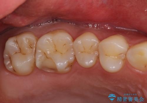 米国で笑われた 保険のつめものをやり直すの治療中