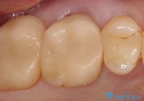 オールセラミッククラウン 根管治療後の補綴の症例 治療前