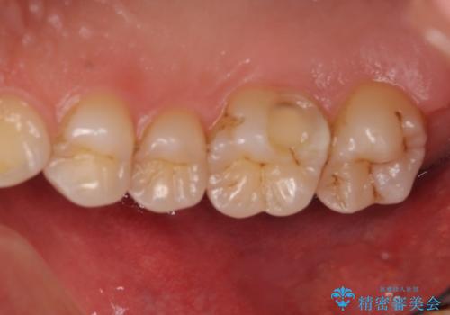 米国で笑われた 保険のつめものをやり直すの治療前