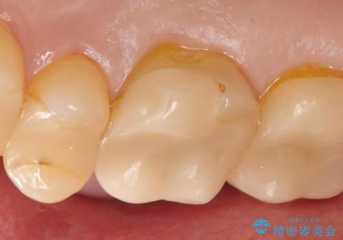 オールセラミッククラウン 根管治療後の補綴の治療前