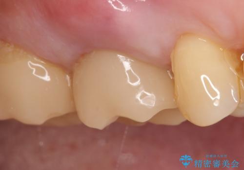 オールセラミッククラウン 根管治療後の補綴の治療前