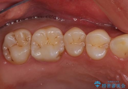 米国で笑われた 保険のつめものをやり直すの治療後