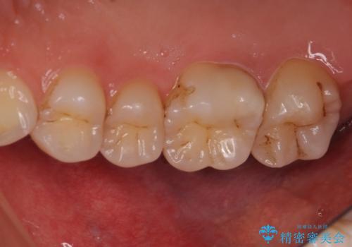 米国で笑われた 保険のつめものをやり直すの症例 治療後