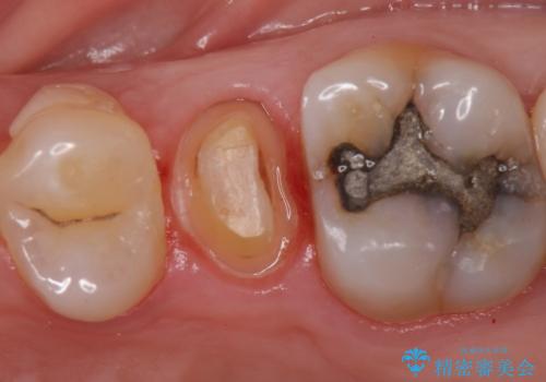 オールセラミッククラウン しみる歯の治療の治療中