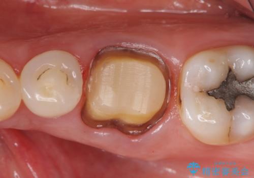 オールセラミッククラウン 根管治療後の補綴の治療中