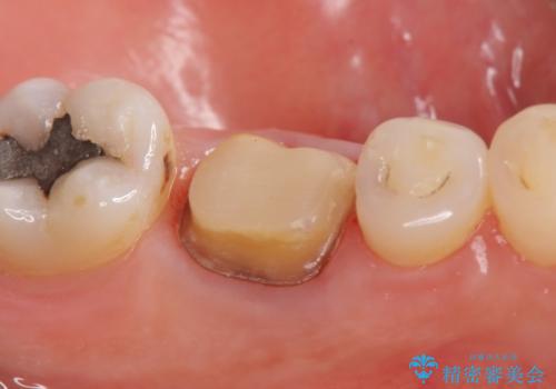 オールセラミッククラウン 根管治療後の補綴の治療中