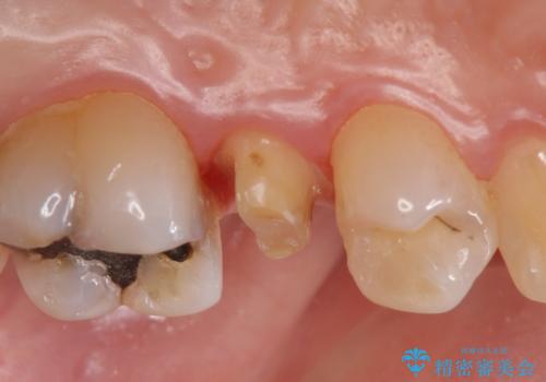 オールセラミッククラウン しみる歯の治療の治療中