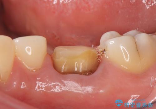 オールセラミッククラウン 根管治療後の補綴の治療中