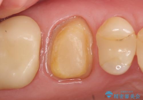 オールセラミッククラウン 根管治療後の補綴の治療中