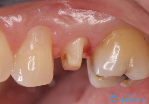 オールセラミッククラウン しみる歯の治療の治療中